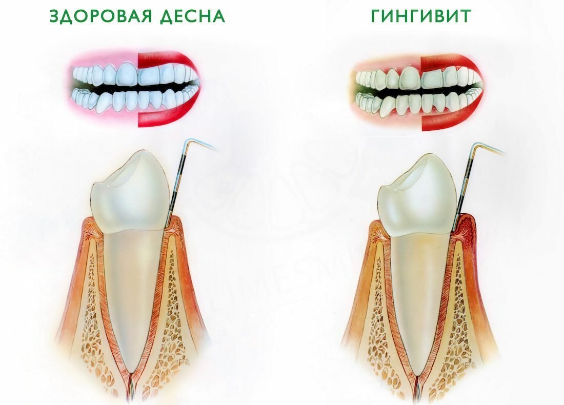 Лечение гингивита